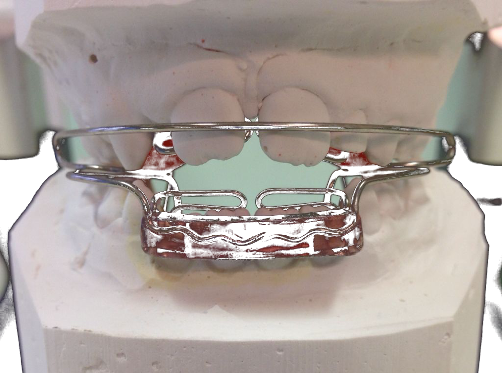 Attivatore di Frankel su modello dentale