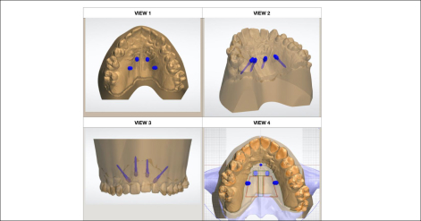 Progettazione ortodontica personalizzata digitale